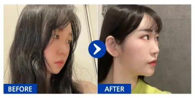 [Бабиток] Хамрын мэс засал / 6 дахь сар / Никнэйм : 횬니횬니야