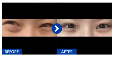 [Ганнам Онни] Нүдний доод өөх шилжүүлэн байрлуулах / 2 дахь сар / Никнэйм : dbgcgghgfd