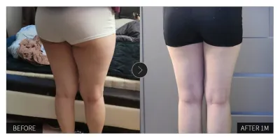 [Gangnam Unni сэтгэгдэл] Өөх соруулах мэс засал хийлгээд 1 сар болж байна / Никнейм: 취저1017