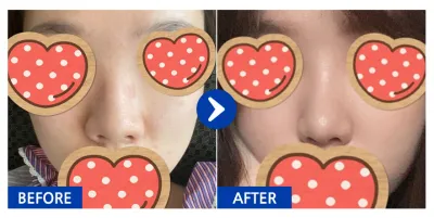 [Gangnam Unni] Хамрын мэс засал / 1 дэх сар / Ник нэр: yyjk3396