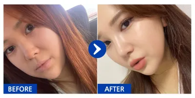 [Babytalk] Хамрын мэс засал / 6 дахь сар / Ник нэр: 반짝가아