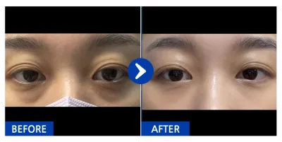 [Gangnam Unni] Нүдний доод өөх дахин хуваарилах / 1 дэх сар / Ник нэр: 이웃집요미