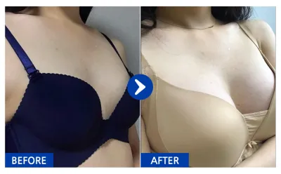 [Babytalk] Хөхний мэс засал / 5 дахь сар / Ник нэр: 정쓔기