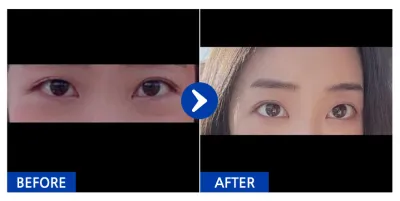 [Babytalk] Нүдний доорх өөх шилжүүлэн суулгах / 1 сар / Никнэйм: kd31