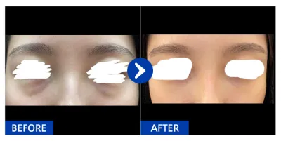 [Babytalk] Нүдний доорх өөх шилжүүлэн суулгах / 1 сар / Никнэйм: 슈슈슈슉슉