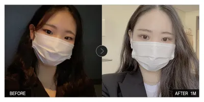 [Gangnam Unni сэтгэгдэл] Нүдний мэс засал хийлгээд 1 сар болж байна / Никнейм: 내눈이니눈