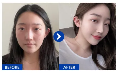 [Babytalk] Хамрын мэс засал (Үйл ажиллагааны + Гоо сайхны) / 2 сар / Никнэйм: atmospe