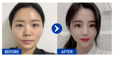 [Бабиток] Нүүрний хэлбэр засах / 3 дахь сар / Никнейм: 문호문