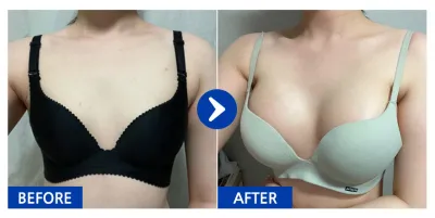 [Бабиток] Хөхний мэс засал / 1 дэх сар / Никнейм: 스물네엣