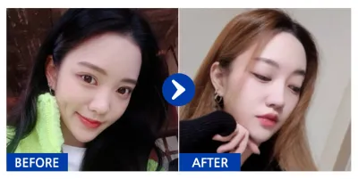 [Ганнам Унни] Хамрын мэс засал / 6 дахь сар / Никнейм: 궁띵