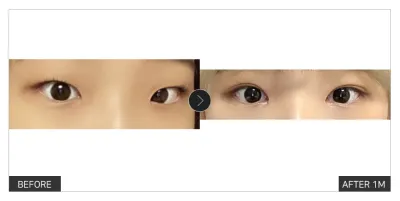 [Gangnam Unni сэтгэгдэл] Нүдний хагалгаа 1 сар болж байна / Ник нэр: meyh