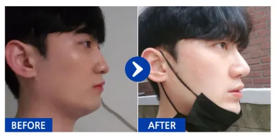 [Ганнам Унни] Хамрын мэс засал / 6 дахь сар / Никнейм: 핵규