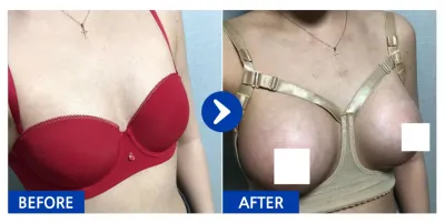 [Бабиток] Хөхний мэс засал / 2 дахь долоо хоног / Никнейм: 에이미언냐