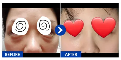 [Ганнам Унни] Нүдний доод өөх дахин хуваарилах / 3 дахь сар / Никнейм: 냐옹홍