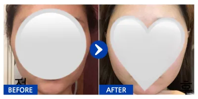 [Gangnam Unni] Нүүрний хэлбэр засах / 1 сар / Никнэйм: daldal2