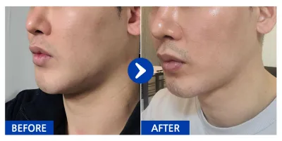 [Babytalk] Нүүрний өөх соруулах / 2 сар / Никнэйм: 굼붕어