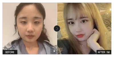 [Babytalk сэтгэгдэл] Нүдний хагалгаа, нүүрний хэлбэр засах хагалгаа 1 сар болж байна / Ник нэр: 지와링