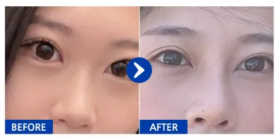 [Gangnam Unni] Хамрын мэс засал / 2 сар / Никнэйм: 옹츄