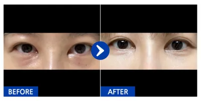 [Gangnam Unni] Нүдний доорх өөх шилжүүлэн суулгах / 1 сар / Никнэйм: anjjjjjjj