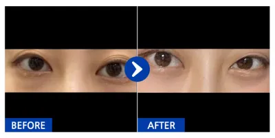 [Gangnam Unni] Нүдний доод өөх засах, Доод зовхи / 1 сар / Никнэйм: 난돋규