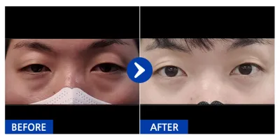 [Babytalk] Нүдний доод өөх засах / 1 сар / Никнэйм: 효듀리