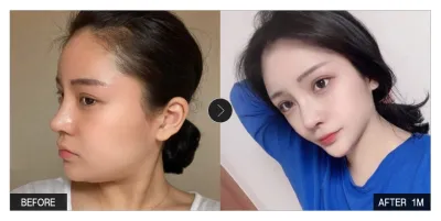 [Gangnam Unni сэтгэгдэл] Нүүрний өөх соруулах 1 сар болж байна / Ник нэр: 솜사탕모구