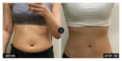 [Gangnam Unni сэтгэгдэл] Өөх соруулах 1 сар болж байна / Ник нэр: 솜사탕모구