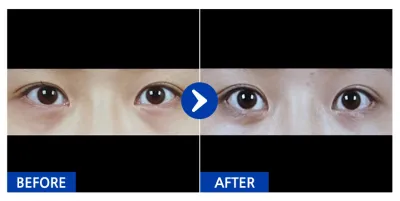 [Babytalk] Дуал тэйм, Нүдний доод өөх засах / 1 сар / Никнэйм: 냐아아아에에용