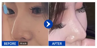 [Gangnam Unni] Хамрын хагалгаа / 1 сар / Никнэйм: skfk2299