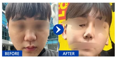 [Gangnam Unni] Хамрын хагалгаа / 2 сар / Никнэйм: 코가고민입니다