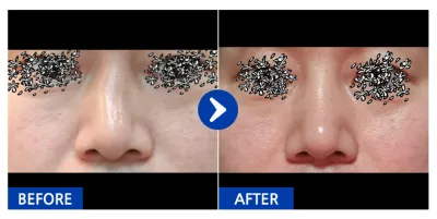 [Babytalk] Хамрын хагалгаа / 1 сар / Никнэйм: 슈퍼츄