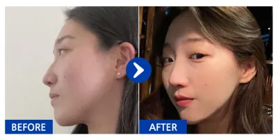 [Babytalk] Хамрын хагалгаа / 1 жил / Никнэйм: atmospe