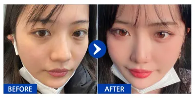 [Ганнам Онни] Нүдний доорх өөх шилжүүлэн суулгах / 6 дахь сар / Никнейм: Ирээдүйн Ганнам гоо бүсгүй