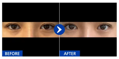 [Ганнам Онни] Нүдний доорх өөх шилжүүлэн суулгах / 1 дэх сар / Никнейм: OooO와