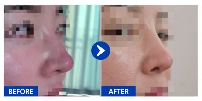 [Babytalk] Хамрын дахин хагалгаа / 1 сар / Никнэйм: 코알라치치