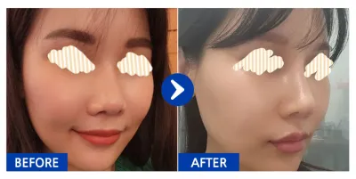 [Babytalk] Хамрын дахин хагалгаа / 1 сар / Никнэйм: wane