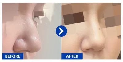 [Gangnam Unni] Хамрын дахин хагалгаа / 1 сар / Никнэйм: jjjejjj