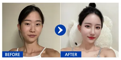 [Gangnam Unni] Нүдний дахин хагалгаа, Нүдний доод өөх засах, Хамар, Нүүрний хэлбэр засах 2 төрөл (Шанаа, Дөрвөлжин эрүү), Хөх (Мотива), Өөх шилжүүлэн суулгах (Дух, Хацар) / 1 сар / Никнэйм: 듀두듀듀