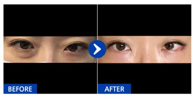 [Babytalk] Нүдний доод өөх засах / 1 сар / Никнэйм: yoouii