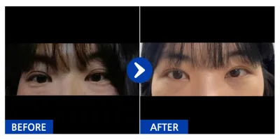 [Gangnam Unni] Нүдний доод өөх засах / 1 сар / Никнэйм: 김ㅇ현