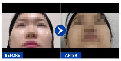 [Gangnam Unni] Нүүрний хэлбэр засах (Шанаа) / 3 долоо хоног / Никнэйм: beami