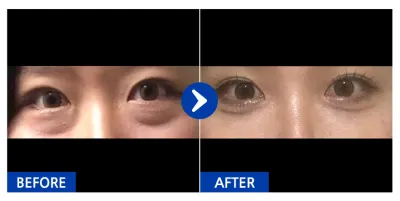 [Gangnam Unni] Нүдний доод өөх засах / 1 сар / Никнэйм: 쓰잉