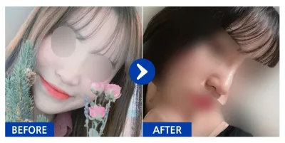 [Gangnam Unni] Хамрын хагалгаа 1 сар / Никнэйм: v1nnn