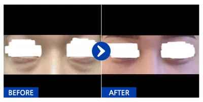 [Gangnam Unni] Нүдний доод өөх засах 1 сар / Никнэйм: iil1ili