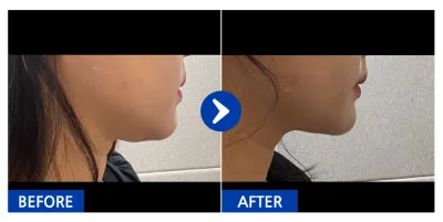 [Gangnam Unni] Нүүрний өөх соруулах 1 сар / Никнэйм: mj_park