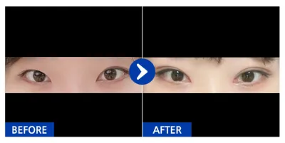 [Gangnam Unni] Байгалийн наалдац (Давхраа), Нүдний дотор булан нээх, Нүдний хэлбэр засах 1 сар / Никнэйм: 포하항푸하항