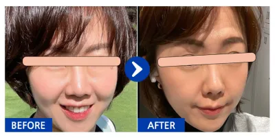 [Gangnam Unni] Нүдний доод өөх засах 1 сар / Никнэйм: 체리콩7