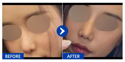 [강남언니] Хамрын дахин хагалгаа 1 сар / Хэрэглэгчийн нэр: huisll_day