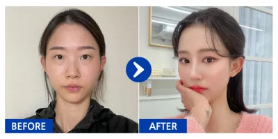 [바비톡] Нүдний дахин хагалгаа, нүдний доод өөх шилжүүлэн байрлуулах, хамар, нүүрний хэлбэр засах 2 төрөл (шанаа, дөр