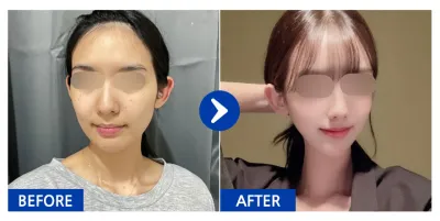 [Gangnam Unni] Нүүрний хэлбэр засах 2 төрөл (эрүү, хацар) 1 сар болсон / Хэрэглэгчийн нэр: Түюри